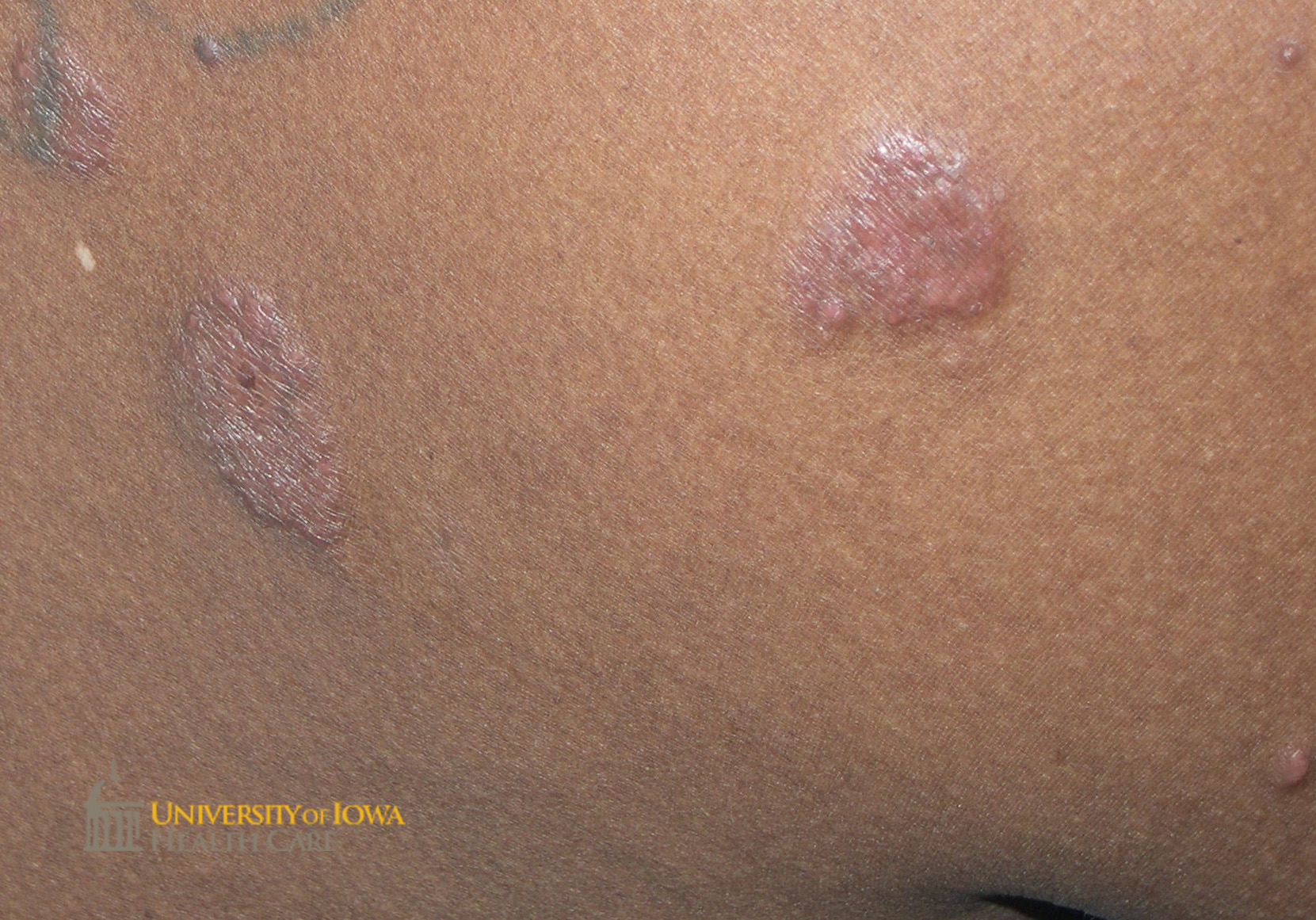 Annular pink plaques and papules on the back. (click images for higher resolution).